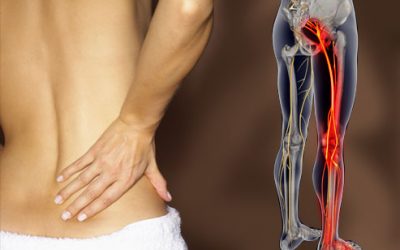 How Do I Know If My Back Pain Is Sciatica?